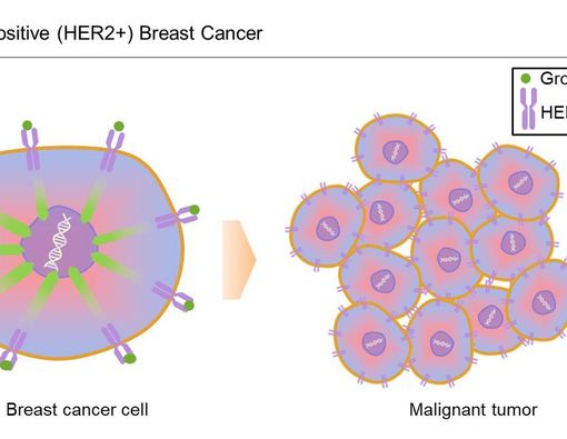 Kanker Payudara HER2 Positif, Kenali Gejala dan Tanda-tandanya