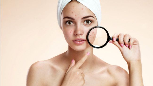 3 Cara Sederhana Hilangkan Jerawat Membandel