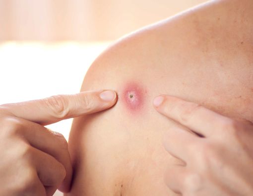 10 Bahan Obat Bisul Alami untuk Bantu Kamu Cepat Sembuh