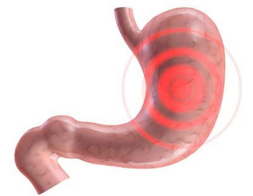 Bisakah Penyakit Maag Disembuhkan?