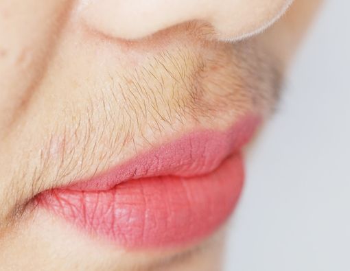 Waspada SAHA Syndrome, Pemicu Pertumbuhan Kumis pada Wanita