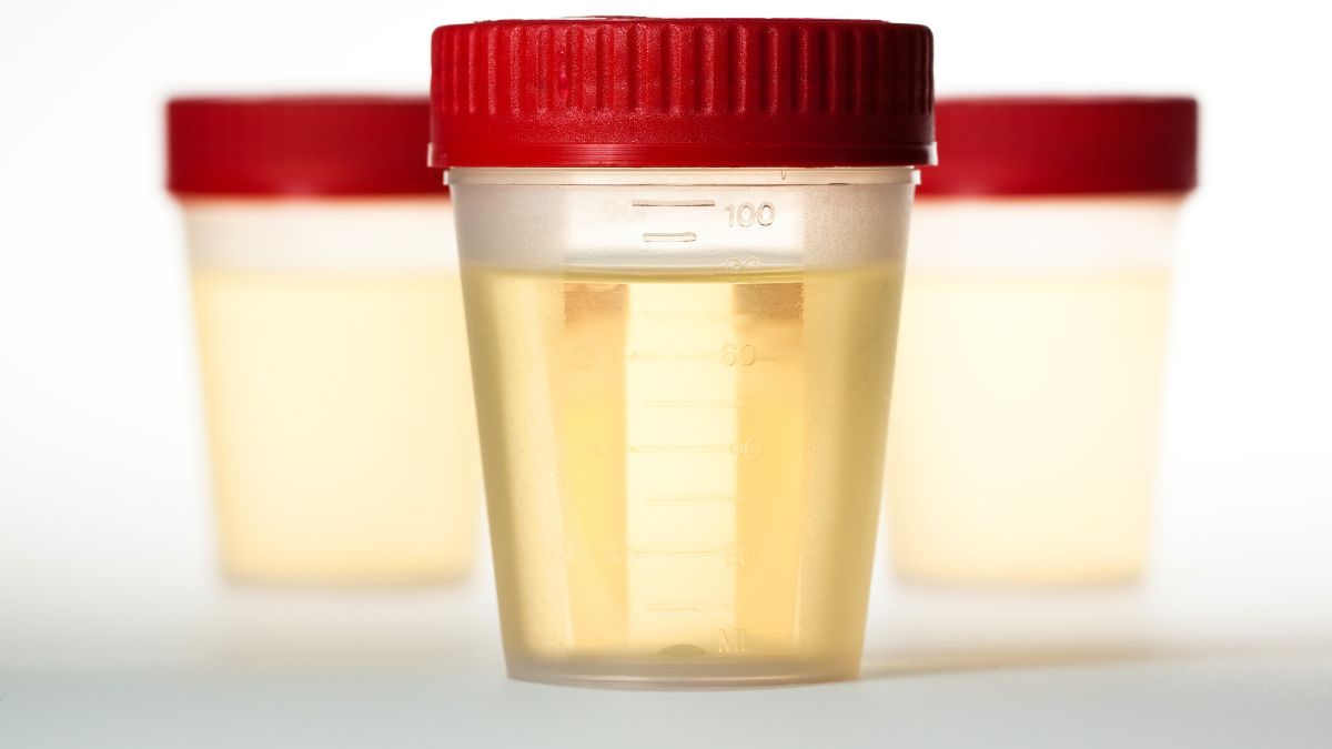 Urine Berwarna Kuning Kecoklatan
