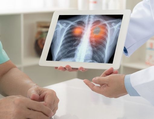 Mengenal Terapi RET Inhibitor untuk Kanker Paru