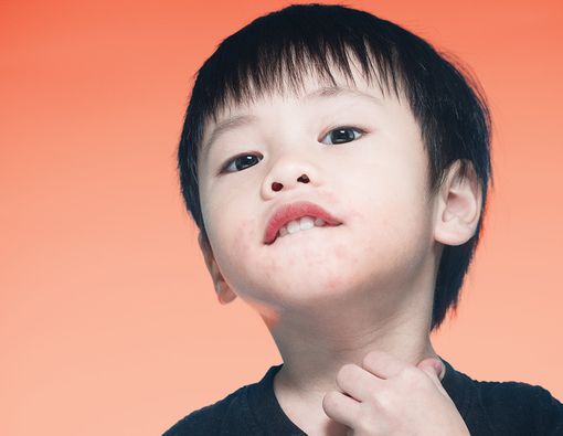 Ciri Si Kecil Alami Alergi Susu Sapi