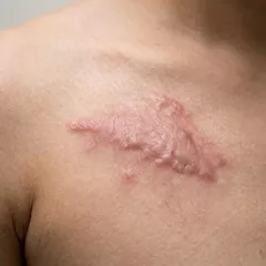 Ciri-Ciri Keloid Berbahaya: Kapan Harus ke Dokter?