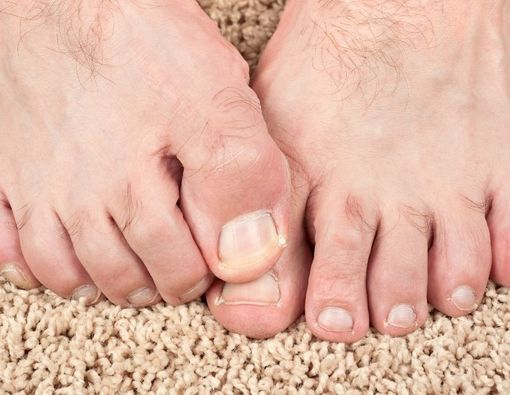 Penyebab Jempol Kaki Bau dan Cara Menghilangkannya