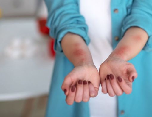 8 Pantangan Biduran agar Tidak Kambuh