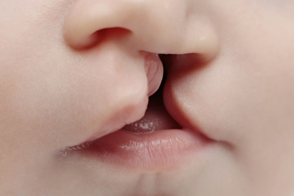 8 Faktor Risiko Penyebab Bibir Sumbing
