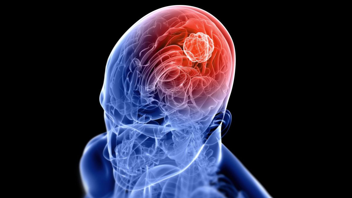 Waspadai 5 Gejala Tumor Otak yang Diam-diam Menyerang