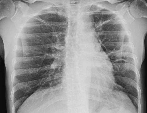 Mengenal Penyebab dan Pengobatan Granuloma Paru