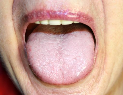 Lidah Anda Bermasalah? Mungkin Ini Sebabnya