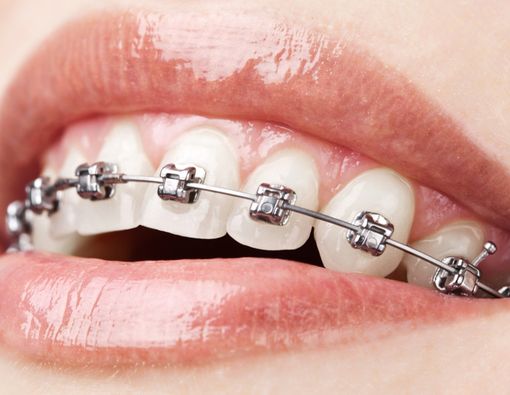 Perhatikan Ini Sebelum Pasang Kawat Gigi