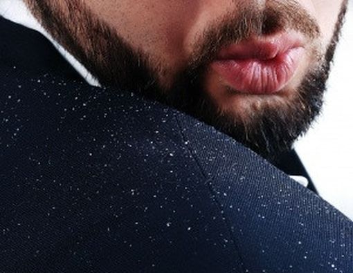 Saran Medis untuk Solusi Ketombe Membandel