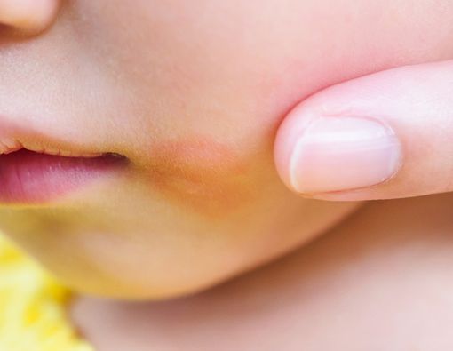 Ruam Merah pada Si Kecil, Apakah Tanda Alergi?