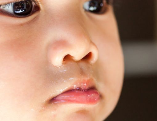 Hidung Sering Ingusan, Gejala Sinusitis?