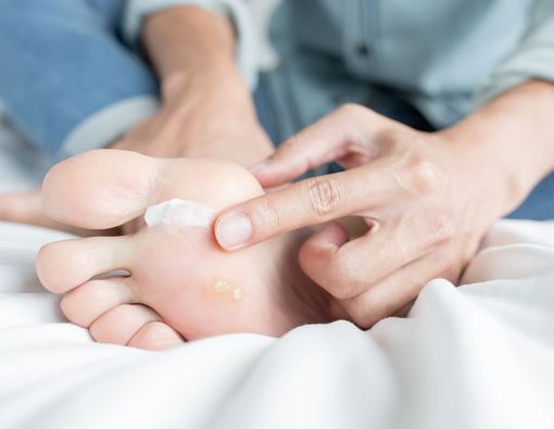 Catat, 7 Cara Menghilangkan Kutu Air Paling Ampuh