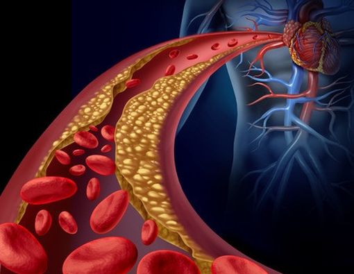 3 Teknik Melawan Kolesterol Tinggi