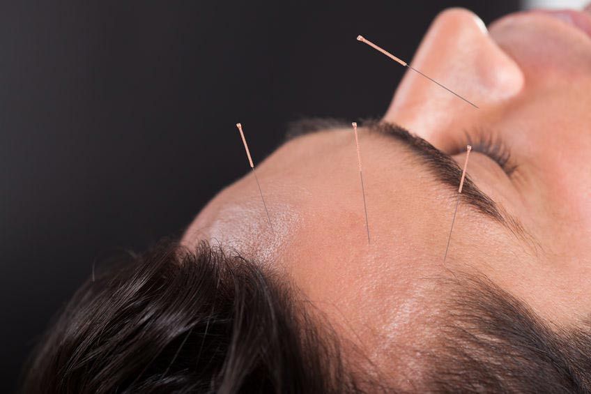 Bisakah Akupunktur Mengobati Nyeri Kepala?