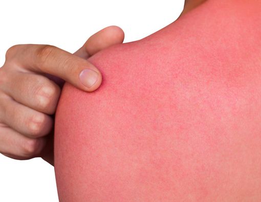 Kenali Perbedaan Alergi Matahari dan Terbakar Matahari