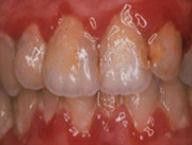Gingivitis