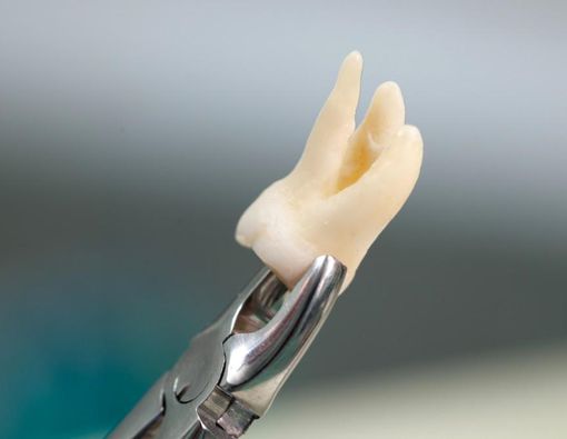 Kenali Berbagai Alat Pencabutan Gigi dan Fungsinya