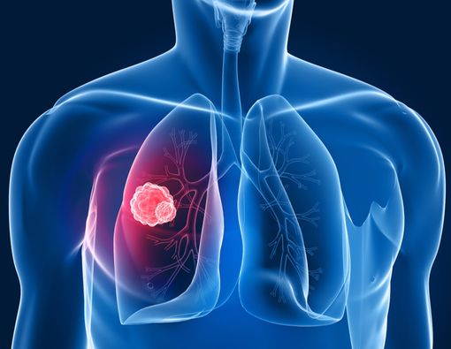 Gejala Kanker Paru Sesuai Stadium