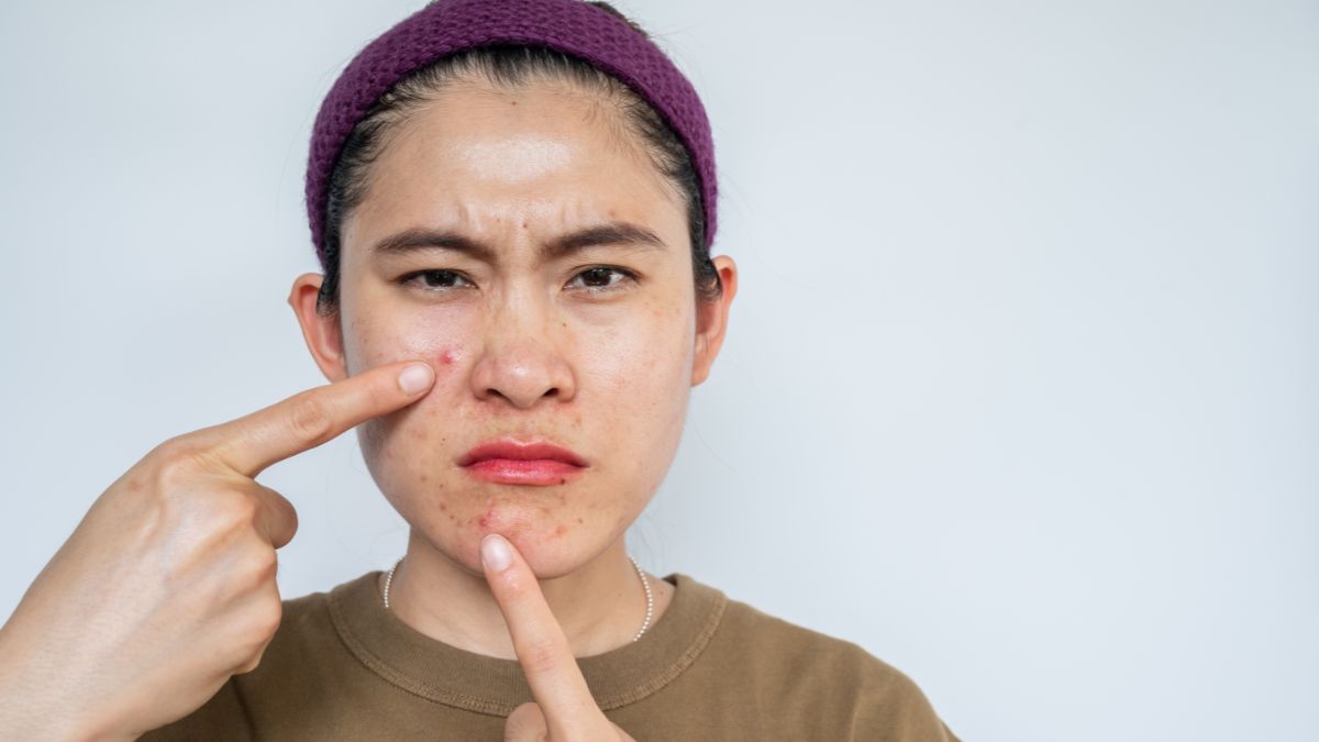 12 Cara Ampuh Menghilangkan Jerawat di Pipi