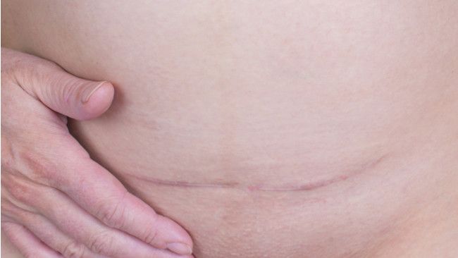 Tips Merawat Luka Operasi Caesar seperti Nikita Mirzani