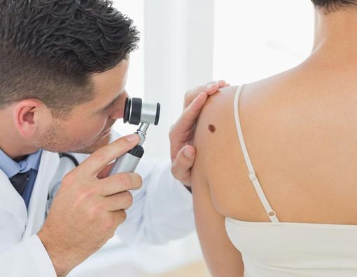 Inilah Tanda Tahi Lalat yang Berbahaya