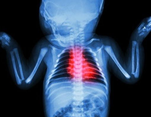 Mengenal Lebih Dekat Penyakit Jantung Bawaan