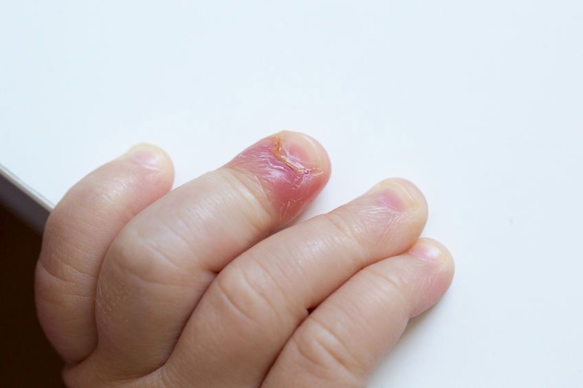 Cara Ampuh Cegah Kuku Cantengan