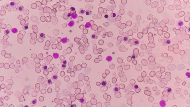 Thalassemia Tak Bisa Disembuhkan?