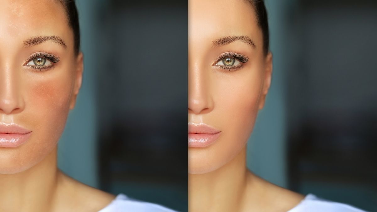 Melasma dan Hiperpigmentasi, Apa Bedanya?