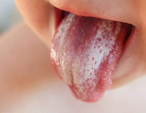 Jangan Sepelekan Bercak Putih di Mulut Bayi
