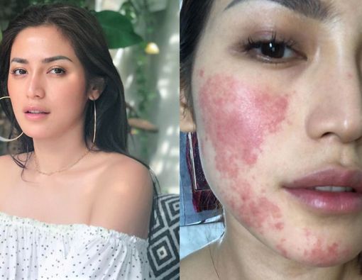 Kenali Alergi Anestesi di Wajah Jessica Iskandar