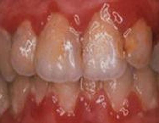 Gingivitis