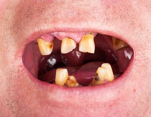 Pria Ini Tidak Gosok Gigi Selama 20 Tahun, Ini Akibatnya