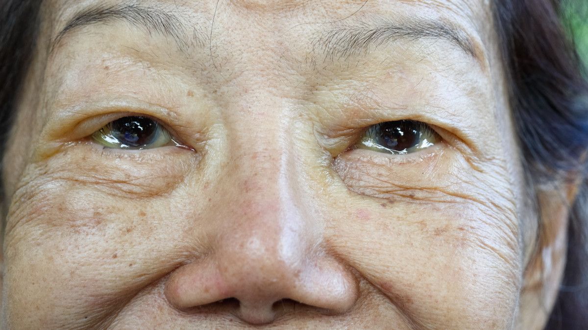 Mengapa Mata Lansia Sering Berair?