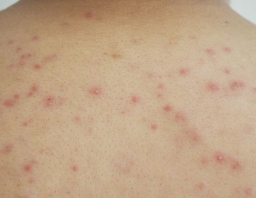 Tips Mengatasi Biang Keringat Saat Ibadah Haji