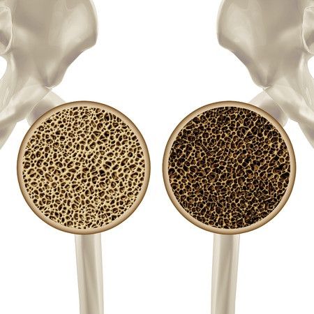 Cara Mencegah Osteoporosis