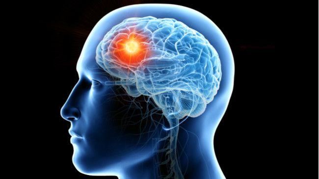 Tanda Tumor Otak Mengintai Anda