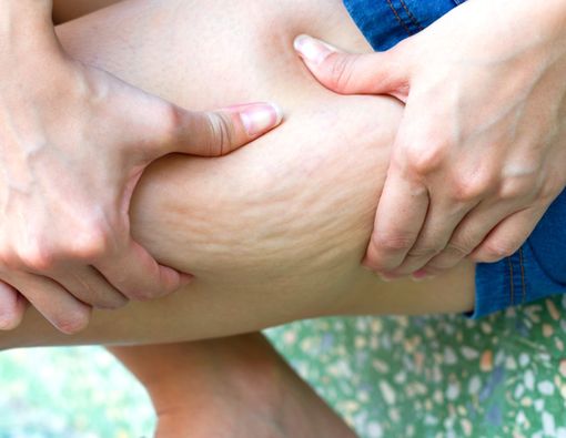 Cara Mencegah Selulit yang Ganggu Penampilan