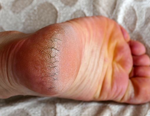 Tumit Pecah-pecah, Atasi dengan Resep Rumahan Ini