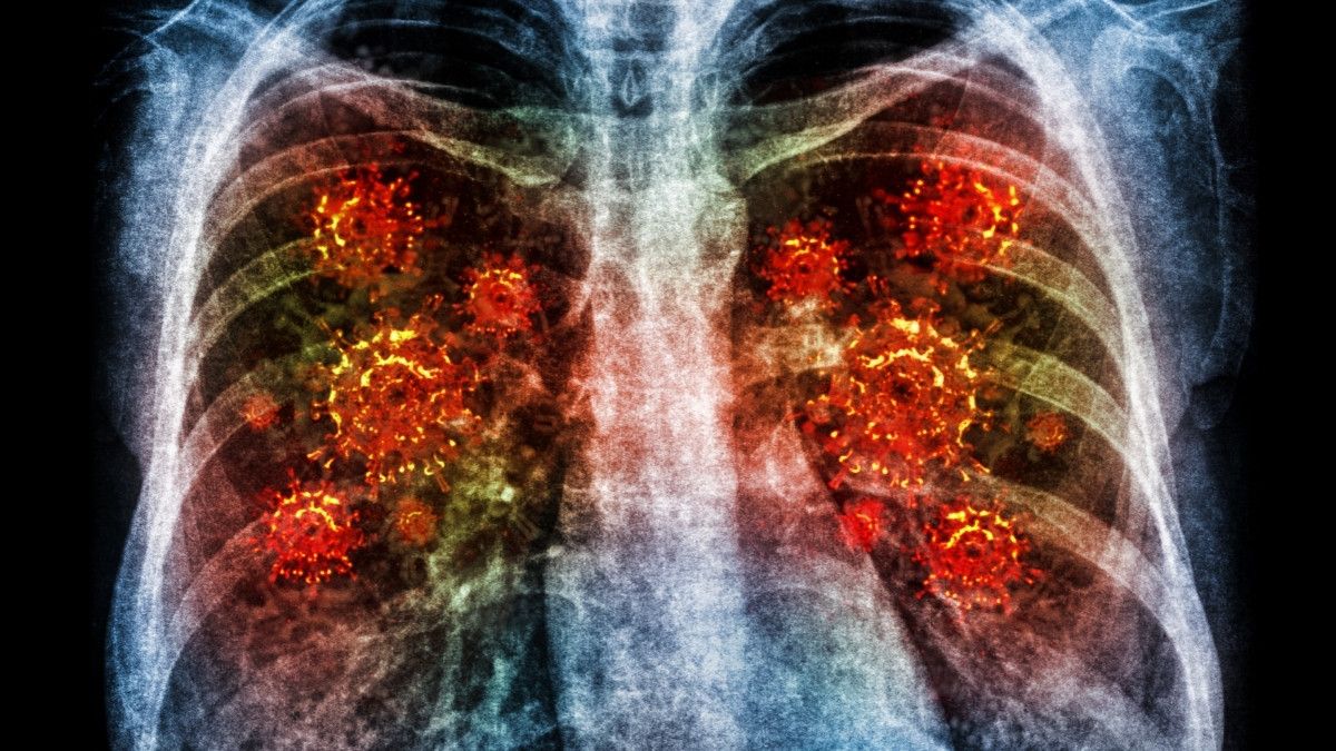 Waspada Bahaya Community-Acquired Pneumonia di Masyarakat