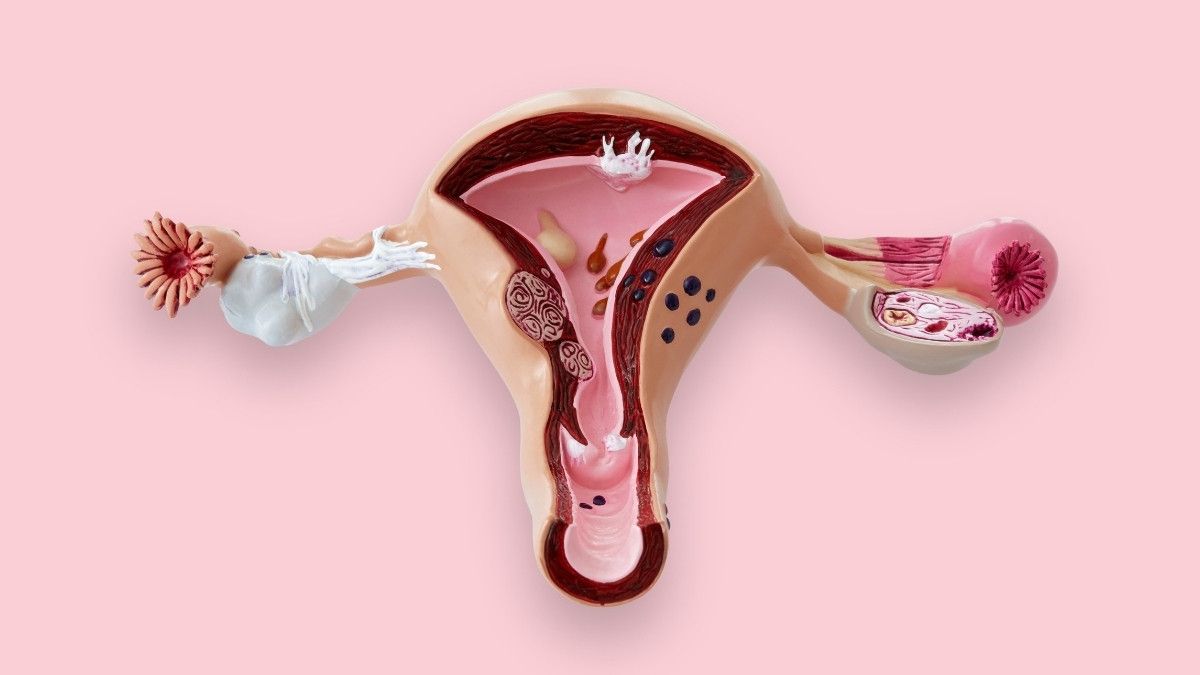 Bisakah Perempuan dengan Kista Ovarium Hamil?