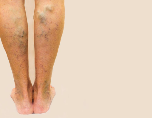 Cara Alami Mengatasi Varises