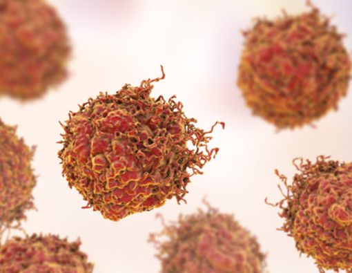 7 Komplikasi Kanker yang Perlu Anda Tahu