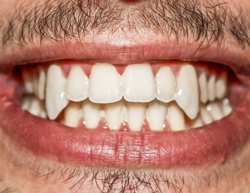 Mirip Drakula, Apa Fungsi Gigi Taring yang Sebenarnya?