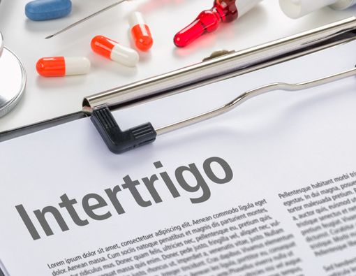 Mengenal Intertrigo, Peradangan Kulit pada Bayi