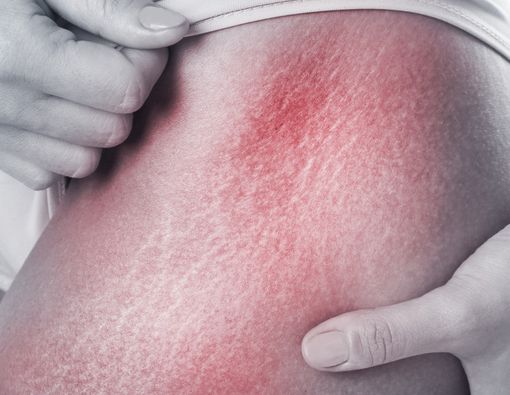 Bukannya Putih, Kulit Jadi Rusak Permanen Akibat Losion Pemutih Palsu